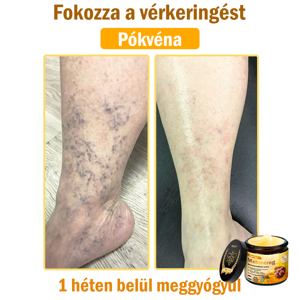 💧💧Bőrgyógyász ajánlása💪ZödVita® Méhméreg Bőrhelyreállító Krém (👨‍⚕‍CE jóváhagyott)👍✅