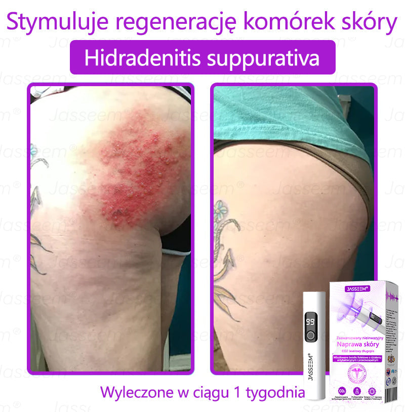 𝐉𝐚𝐬𝐬𝐞𝐞𝐦® Zaawansowany nieinwazyjny laser CO₂ do naprawy skóry 🎉 (Delikatnie usuwa brodawki, znamiona, plamy starcze i narośla skórne – bez bólu, bez zamieszania!)