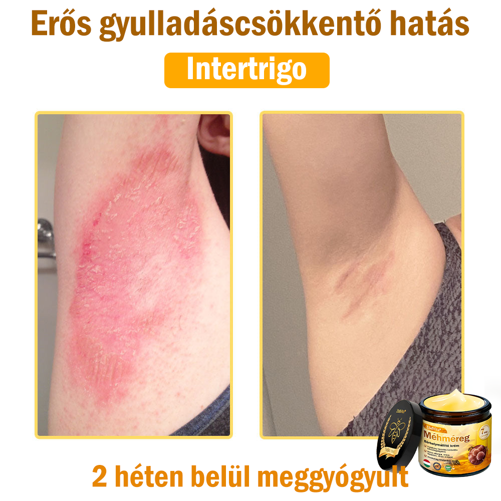 💧💧Bőrgyógyász ajánlása💪ZödVita® Méhméreg Bőrhelyreállító Krém (👨‍⚕‍CE jóváhagyott)👍✅