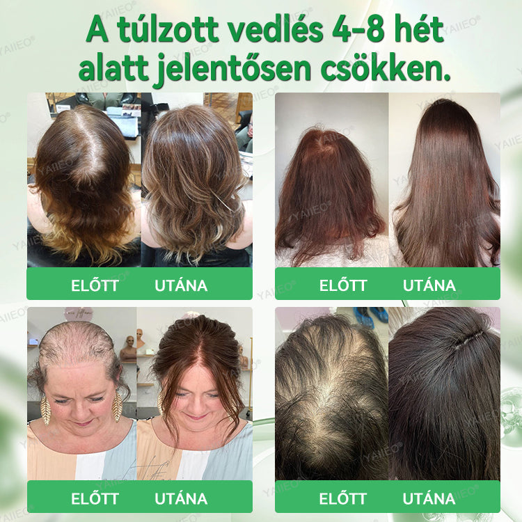 🍎🍎YAIIEO® 𝑭á𝒋𝒅𝒂𝒍𝒐𝒎𝒎𝒆𝒏𝒕𝒆𝒔 𝑴𝒊𝒌𝒓𝒐𝒊𝒏𝒇ú𝒛𝒊ó𝒔 𝑹𝒆𝒏𝒅𝒔𝒛𝒆𝒓 Mélyen ható DHT-blokkolás, hajhagymák újraaktiválása és látható hajnövekedés