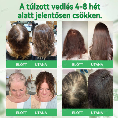 🍎🍎YAIIEO® 𝑭á𝒋𝒅𝒂𝒍𝒐𝒎𝒎𝒆𝒏𝒕𝒆𝒔 𝑴𝒊𝒌𝒓𝒐𝒊𝒏𝒇ú𝒛𝒊ó𝒔 𝑹𝒆𝒏𝒅𝒔𝒛𝒆𝒓 Mélyen ható DHT-blokkolás, hajhagymák újraaktiválása és látható hajnövekedés