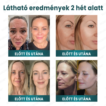🌿 NORUION® Q10 x Növényi Nano Exoszóma Haladó Ránctalanító Krém