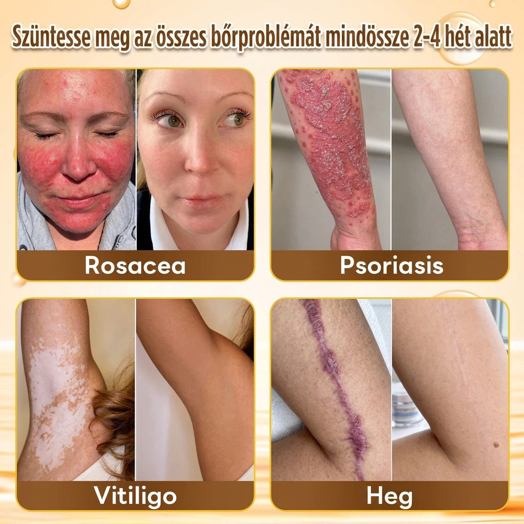 ✨PuraCure® TÖBBFÉLE BŐRPROBLÉMÁRA HATÓ MÉHMÉREG MIKROTŰS BŐRREGENERÁLÓ TAPASZOK