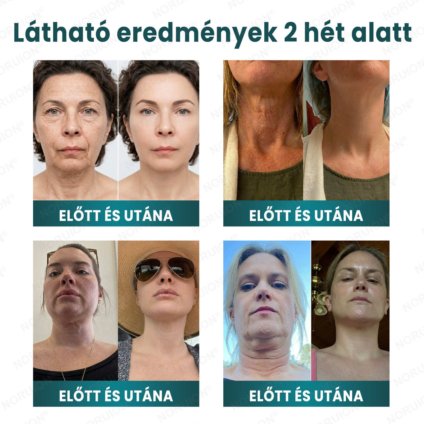 🌿 NORUION® Q10 x Növényi Nano Exoszóma Haladó Ránctalanító Krém