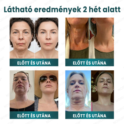 🌿 NORUION® Q10 x Növényi Nano Exoszóma Haladó Ránctalanító Krém