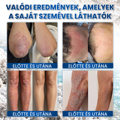 🌿Medistart® PSZORIÁZIS SPECIÁLIS BŐRÁPOLÓ