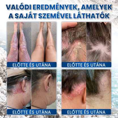 🌿Medistart® PSZORIÁZIS SPECIÁLIS BŐRÁPOLÓ
