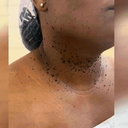 𝐉𝐚𝐬𝐬𝐞𝐞𝐦® Zaawansowany nieinwazyjny laser CO₂ do naprawy skóry 🎉 (Delikatnie usuwa brodawki, znamiona, plamy starcze i narośla skórne – bez bólu, bez zamieszania!)