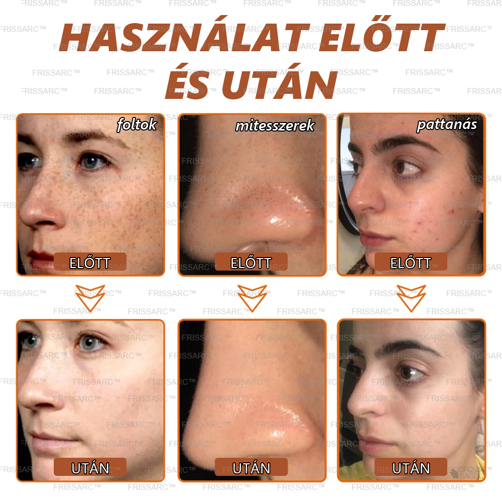𝐅𝐑𝐈𝐒𝐒𝐀𝐑𝐂™ Fehérítő És Folteltávolító Arcmaszk | Természetes összetevők tartósan eltüntetik a foltokat, szeplőket és napfoltokat