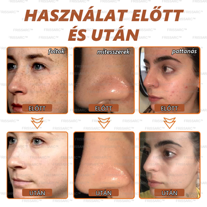 𝐅𝐑𝐈𝐒𝐒𝐀𝐑𝐂™ Fehérítő És Folteltávolító Arcmaszk | Természetes összetevők tartósan eltüntetik a foltokat, szeplőket és napfoltokat