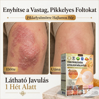 ✨PuraCure® TÖBBFÉLE BŐRPROBLÉMÁRA HATÓ MÉHMÉREG MIKROTŰS BŐRREGENERÁLÓ TAPASZOK