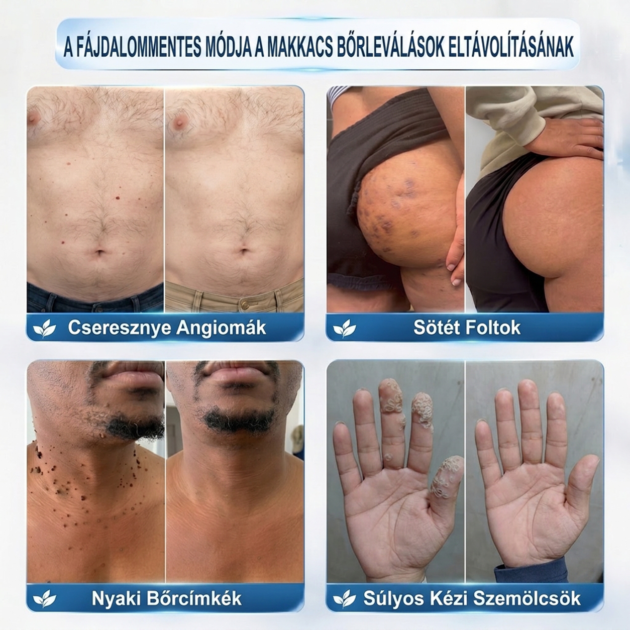 🌿𝐏𝐮𝐫𝐚𝐂𝐮𝐫𝐞® 👩‍⚕️ 𝟕 𝐍𝐚𝐩𝐨𝐬 Bőrkinövés- és Folteltávolító Toll Fájdalommentes és Hegmentes Professzionális Rollerball