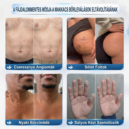 🌿𝐏𝐮𝐫𝐚𝐂𝐮𝐫𝐞® 👩‍⚕️ 𝟕 𝐍𝐚𝐩𝐨𝐬 Bőrkinövés- és Folteltávolító Toll Fájdalommentes és Hegmentes Professzionális Rollerball