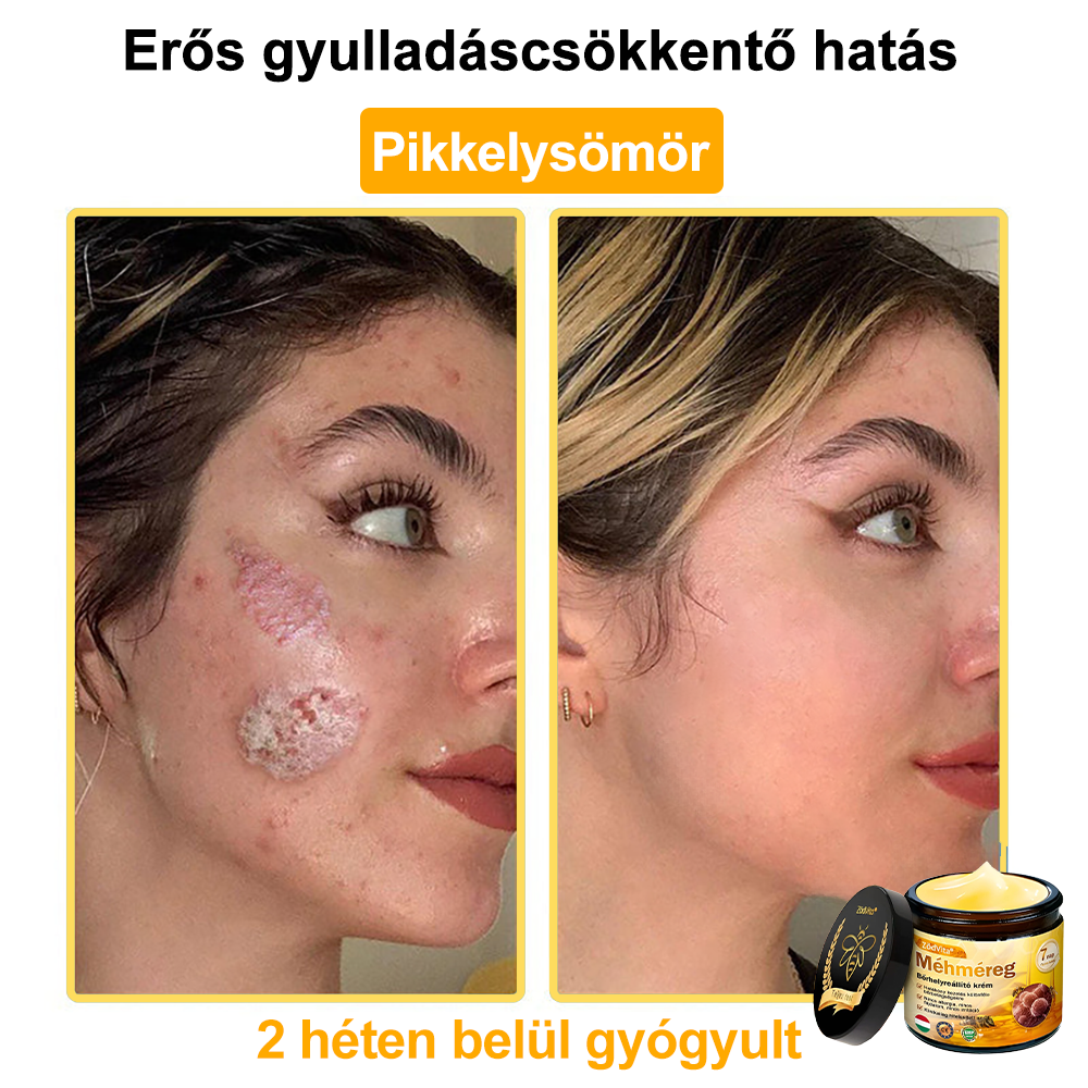 💧💧Bőrgyógyász ajánlása💪ZödVita® Méhméreg Bőrhelyreállító Krém (👨‍⚕‍CE jóváhagyott)👍✅