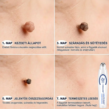 🌿𝐏𝐮𝐫𝐚𝐂𝐮𝐫𝐞® 👩‍⚕️ 𝟕 𝐍𝐚𝐩𝐨𝐬 Bőrkinövés- és Folteltávolító Toll Fájdalommentes és Hegmentes Professzionális Rollerball