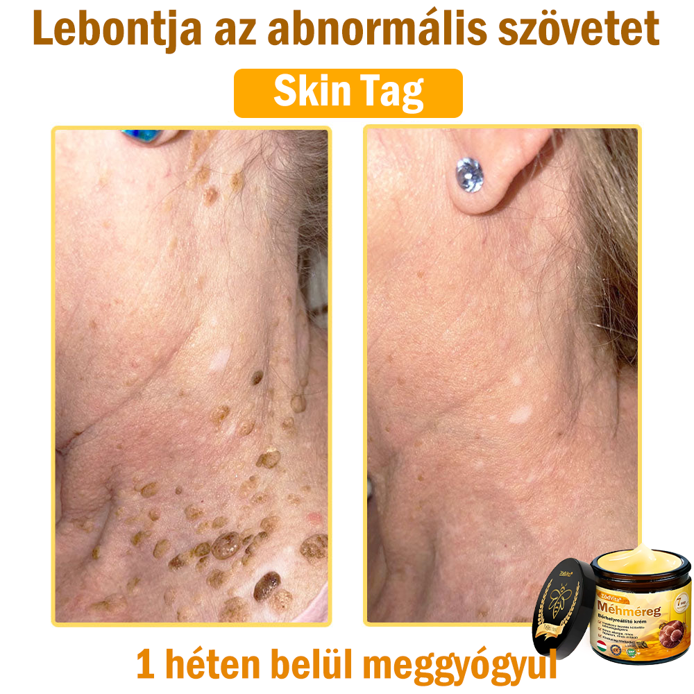 💧💧Bőrgyógyász ajánlása💪ZödVita® Méhméreg Bőrhelyreállító Krém (👨‍⚕‍CE jóváhagyott)👍✅