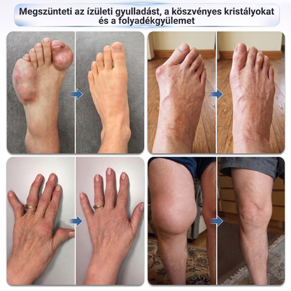 🌿🌿 Már csak 5 darab maradt! Szerezzen most extra 50% kedvezményt, és támogassa ízületei mindennapi komfortját a Medistart® mikrotűs Roll-Onnal! 🦴✨