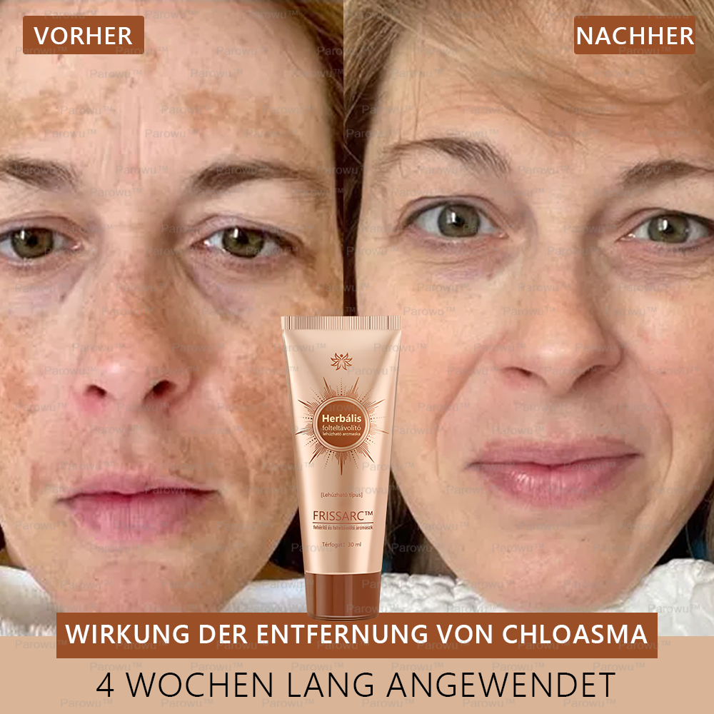 𝐅𝐑𝐈𝐒𝐒𝐀𝐑𝐂™ Fehérítő És Folteltávolító Arcmaszk | Természetes összetevők tartósan eltüntetik a foltokat, szeplőket és napfoltokat